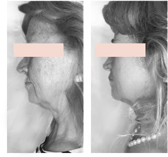 Resultado antes y después