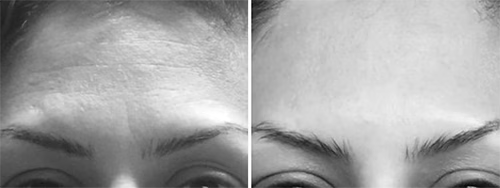 Resultado antes y después