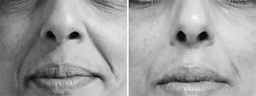Resultado antes y después